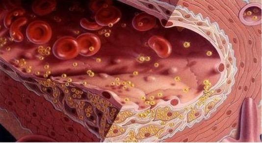 Bệnh mỡ máu có nguy hiểm không?