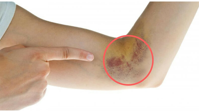 Tiểu đường biểu hiện trên da