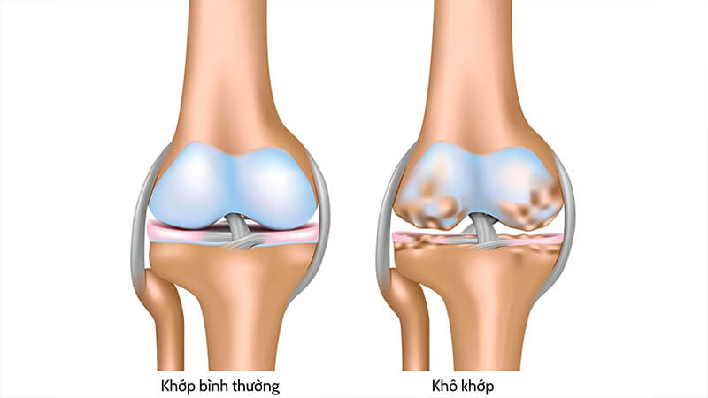 Khớp bị cứng