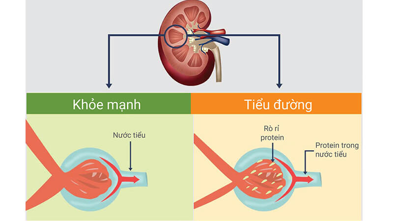 tiểu đường gây biến chứng suy thận